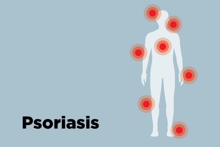 outline of body showing psoriasis hotspots