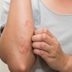 8 Home Remedies for Skin Rashes That Your Body Will Thank You For