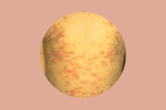 Guttate psoriasis on a man's torso.