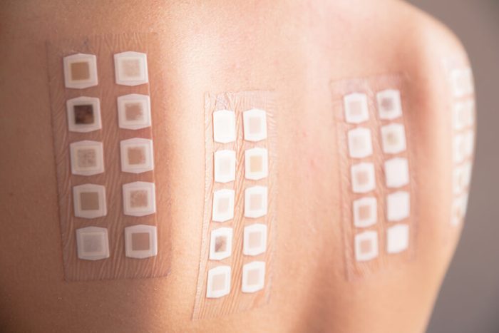 Alergy patch test on the back of a young woman