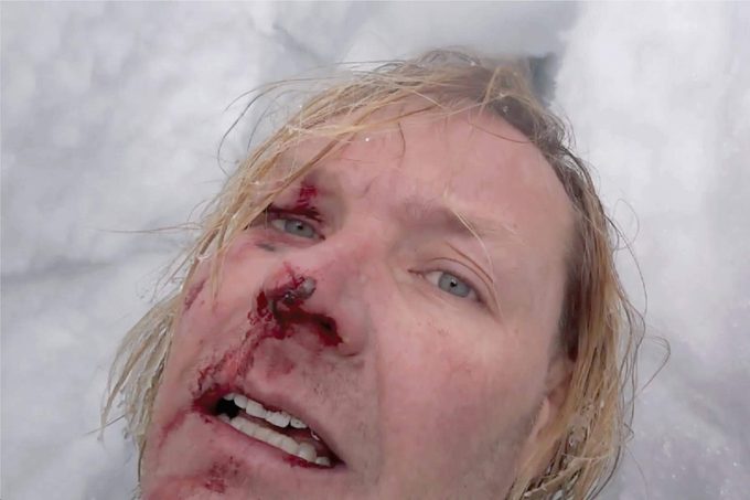 John All's face after falling