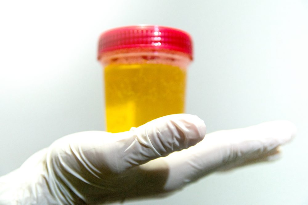 hand with urine container