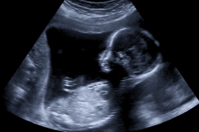 Ultrasound of baby in mother's womb.