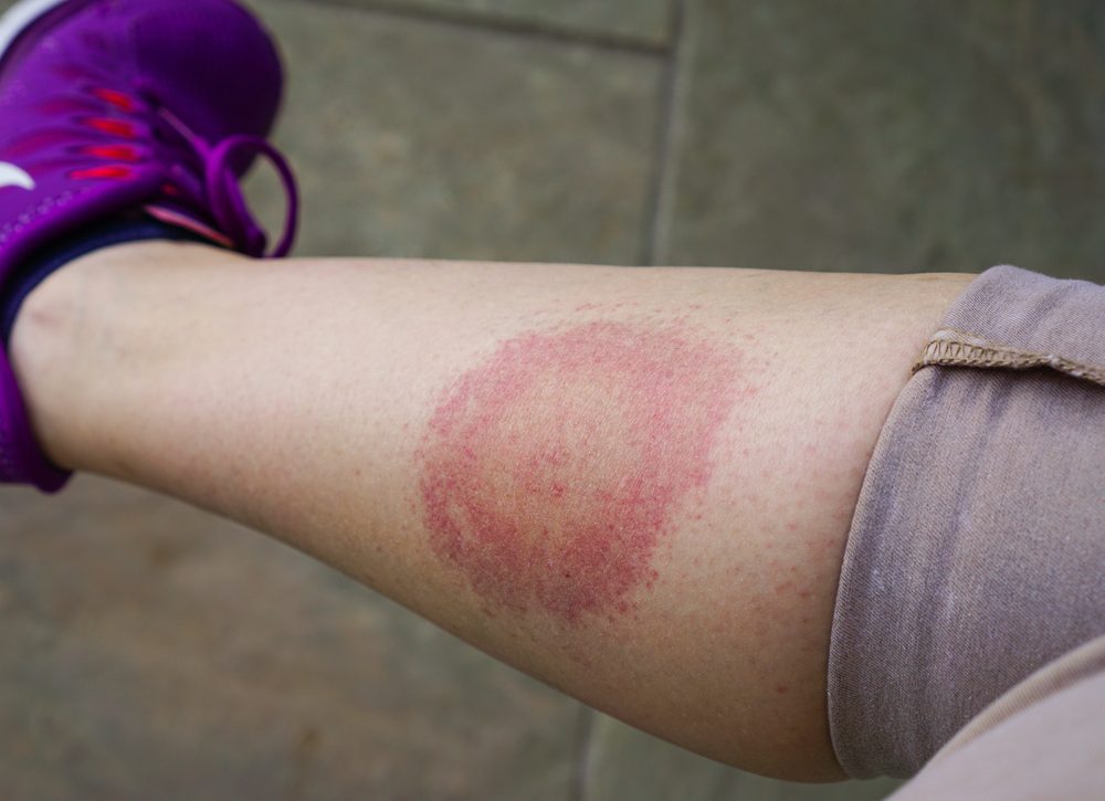 lyme disease rash