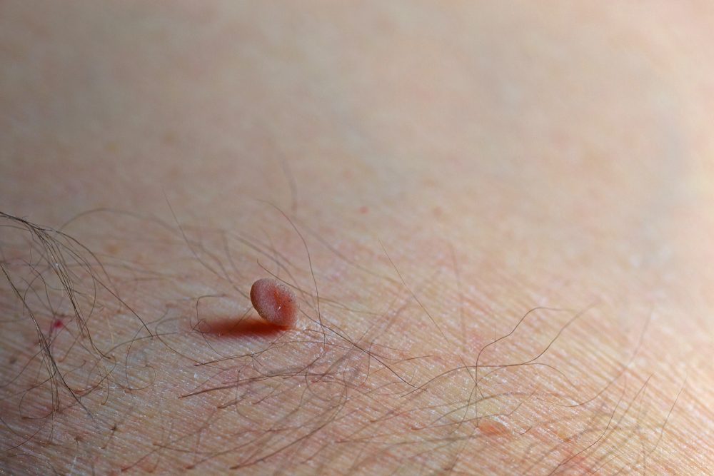 skin tag