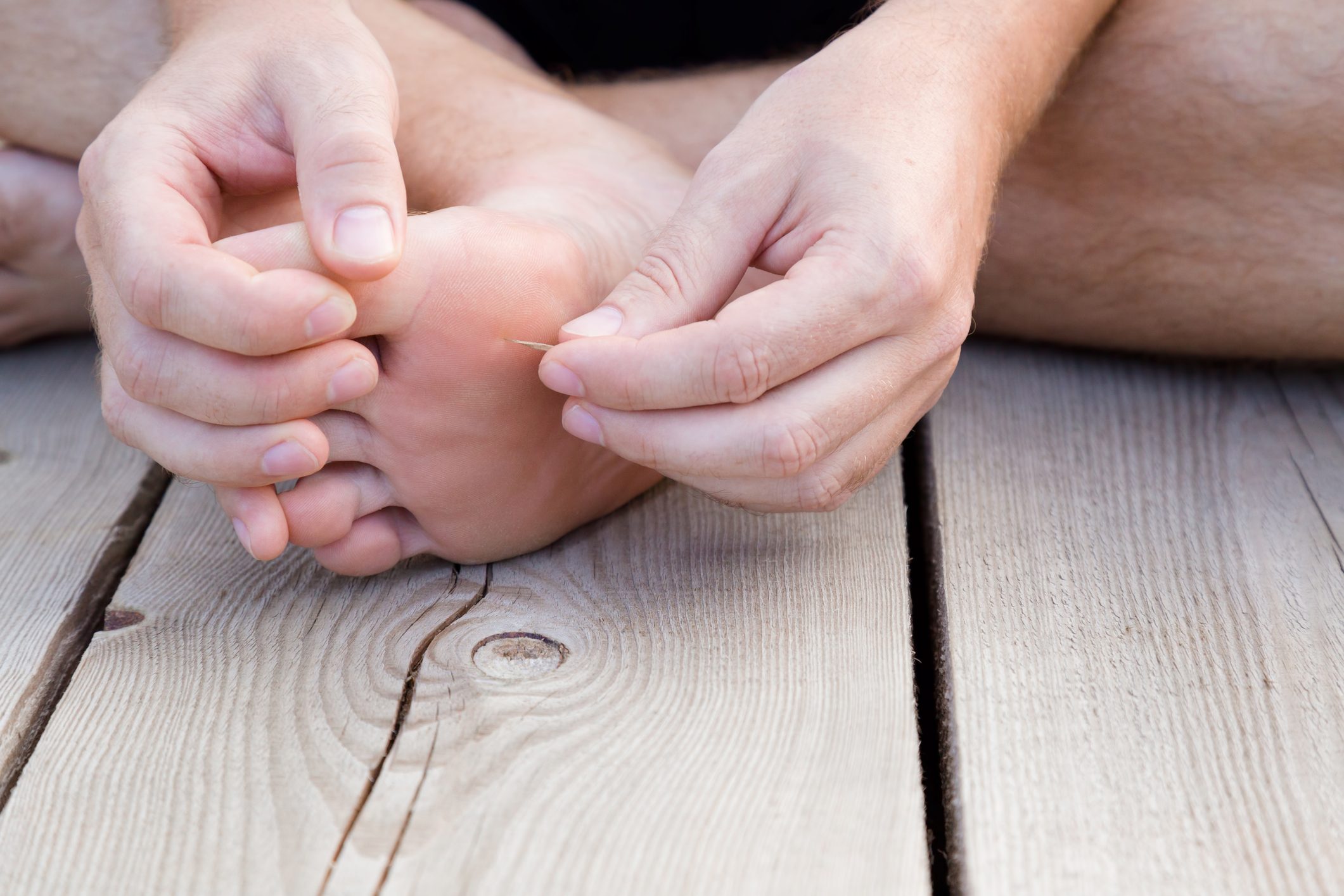 man removing splinter from foot