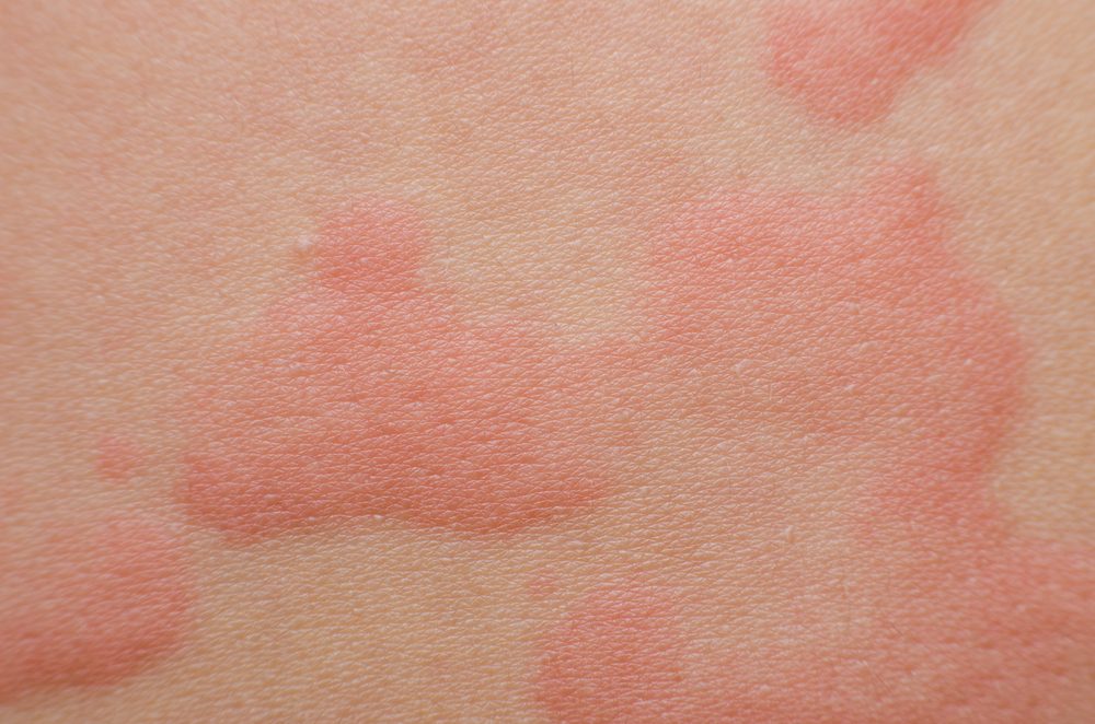 Close up Allergy rash, Around Back view of human with dermatitis problem of rash ,Allergy rash and Health problem.