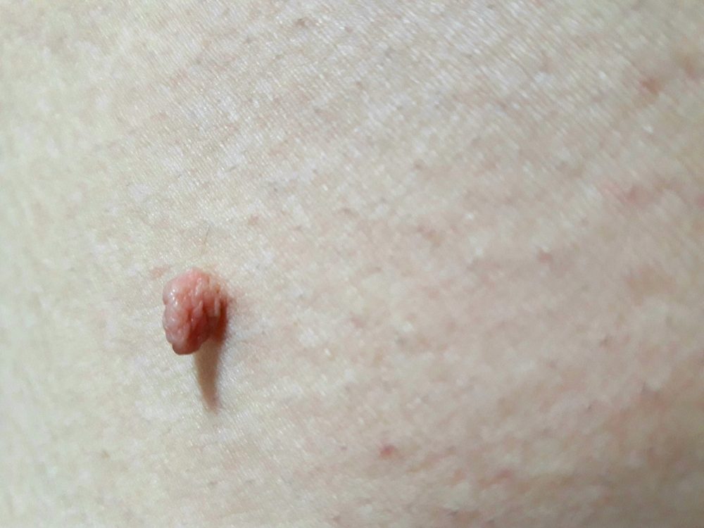 Acrochordon /skin tag