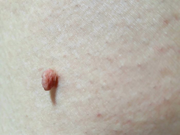 Acrochordon /skin tag
