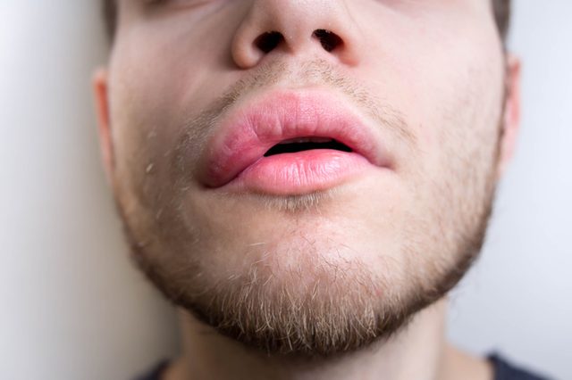 asymmetry of the face in stroke. twisted lips.