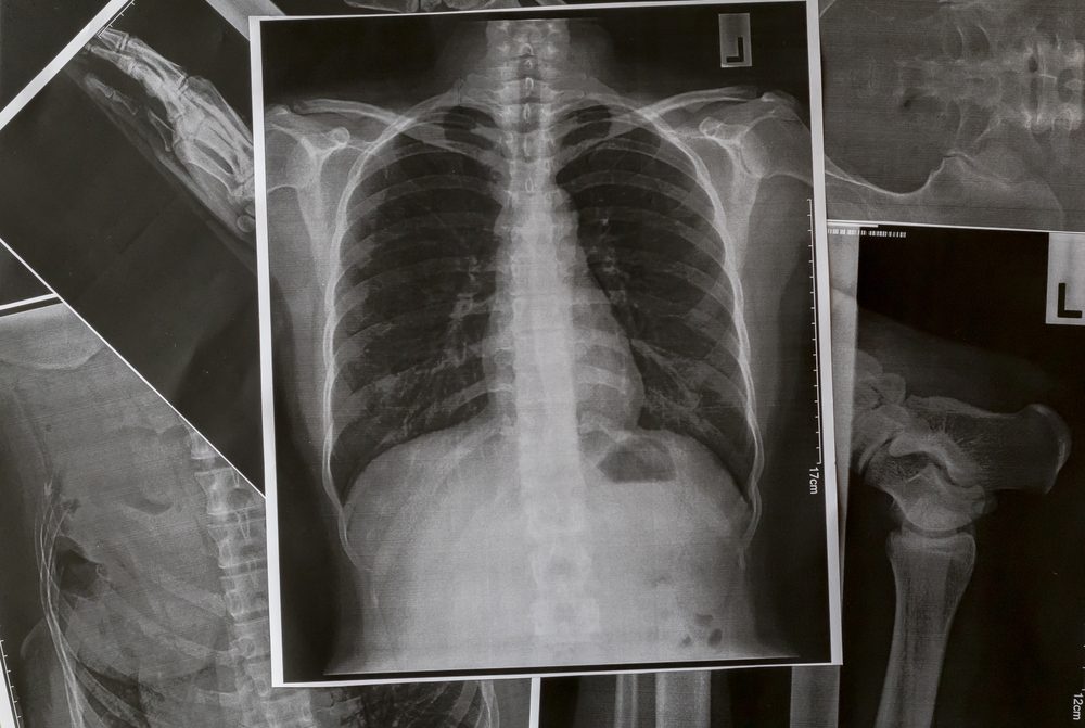 X-Ray Image Of Human Chest for a medical diagnosis.Chest and lungs Xray photo