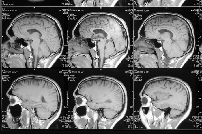 black and white head magnetic resonance image