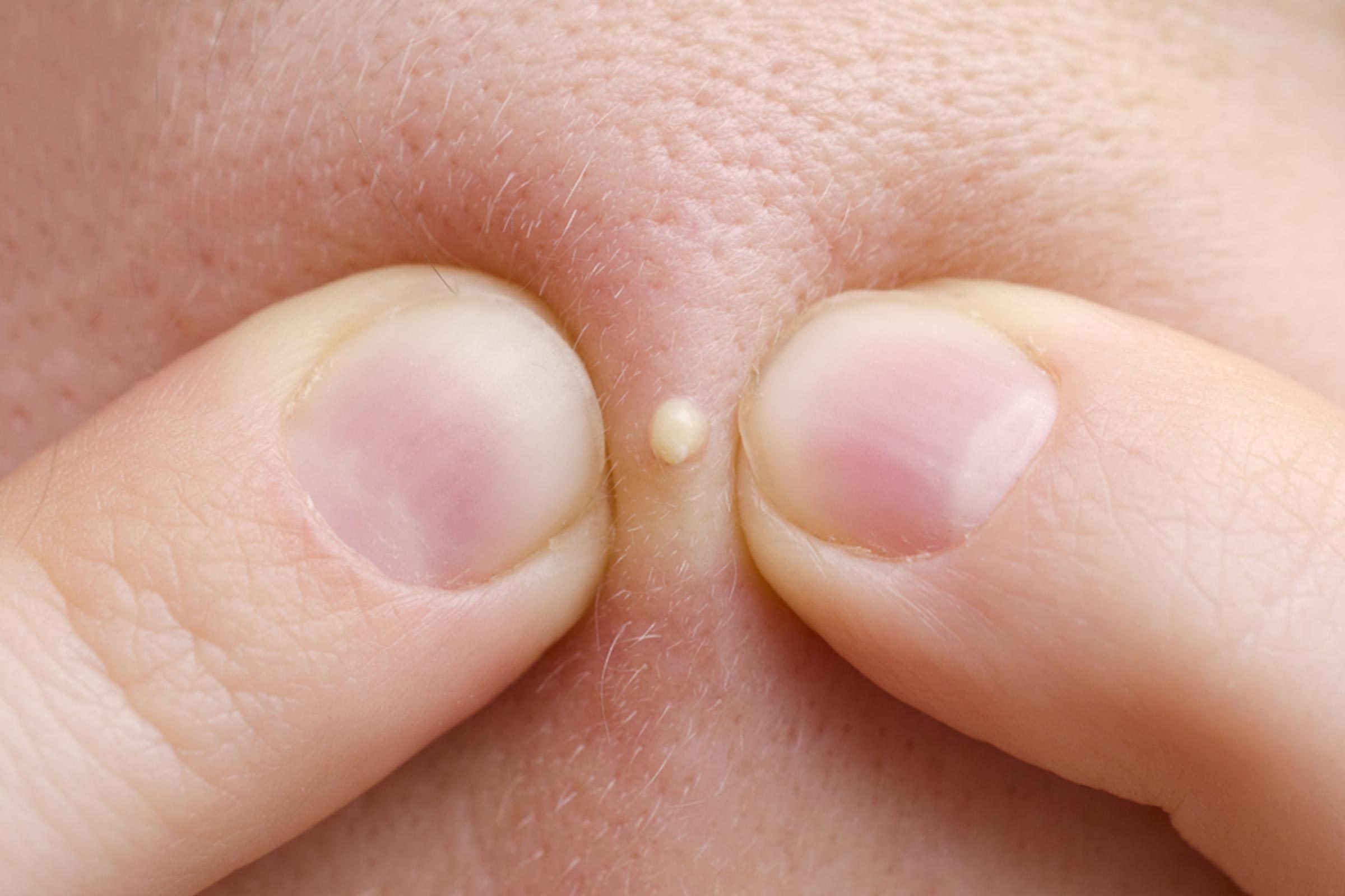 13 Silent Signs of Skin Cancer You're Probably Ignoring