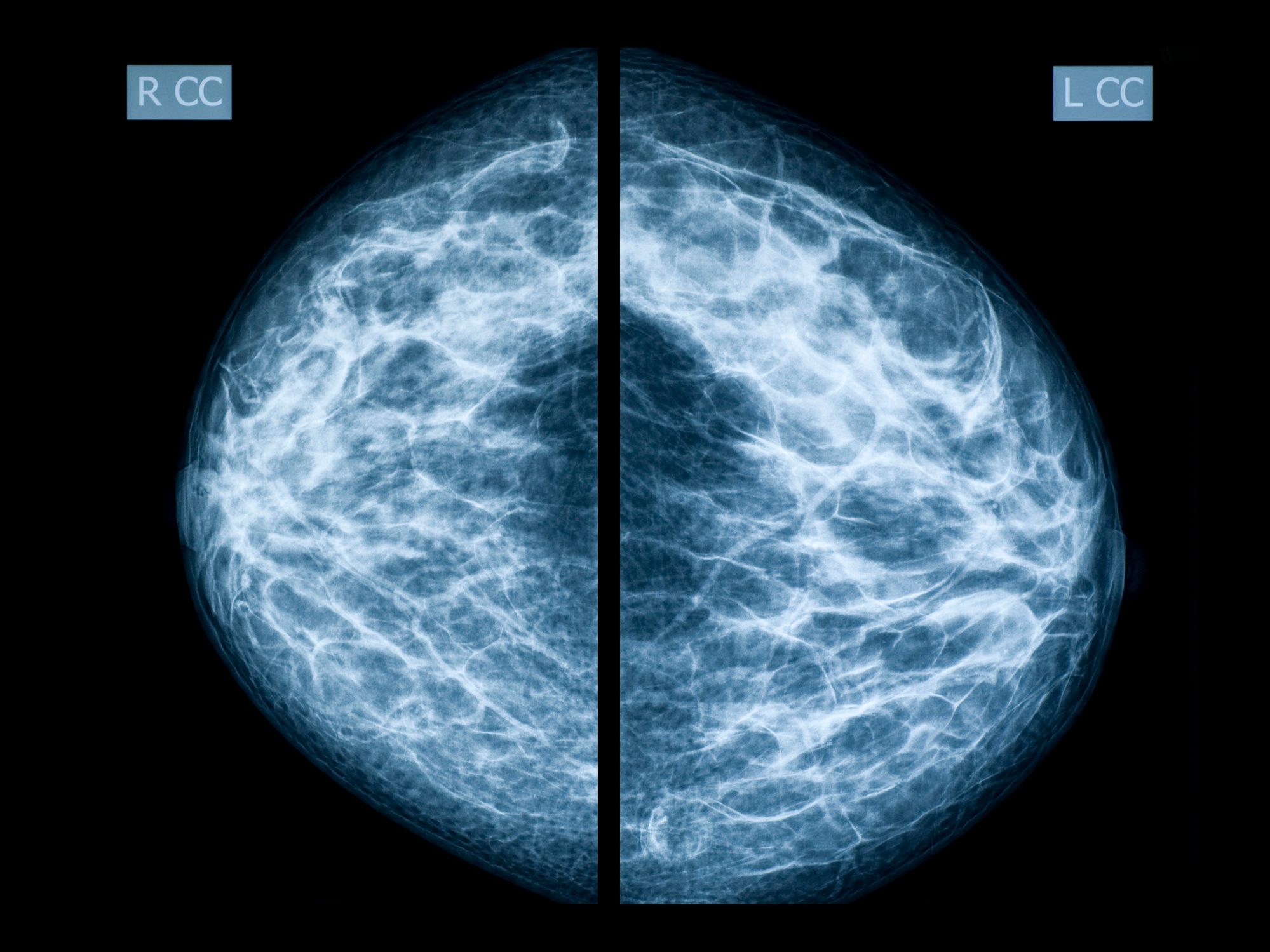 mammogram scan