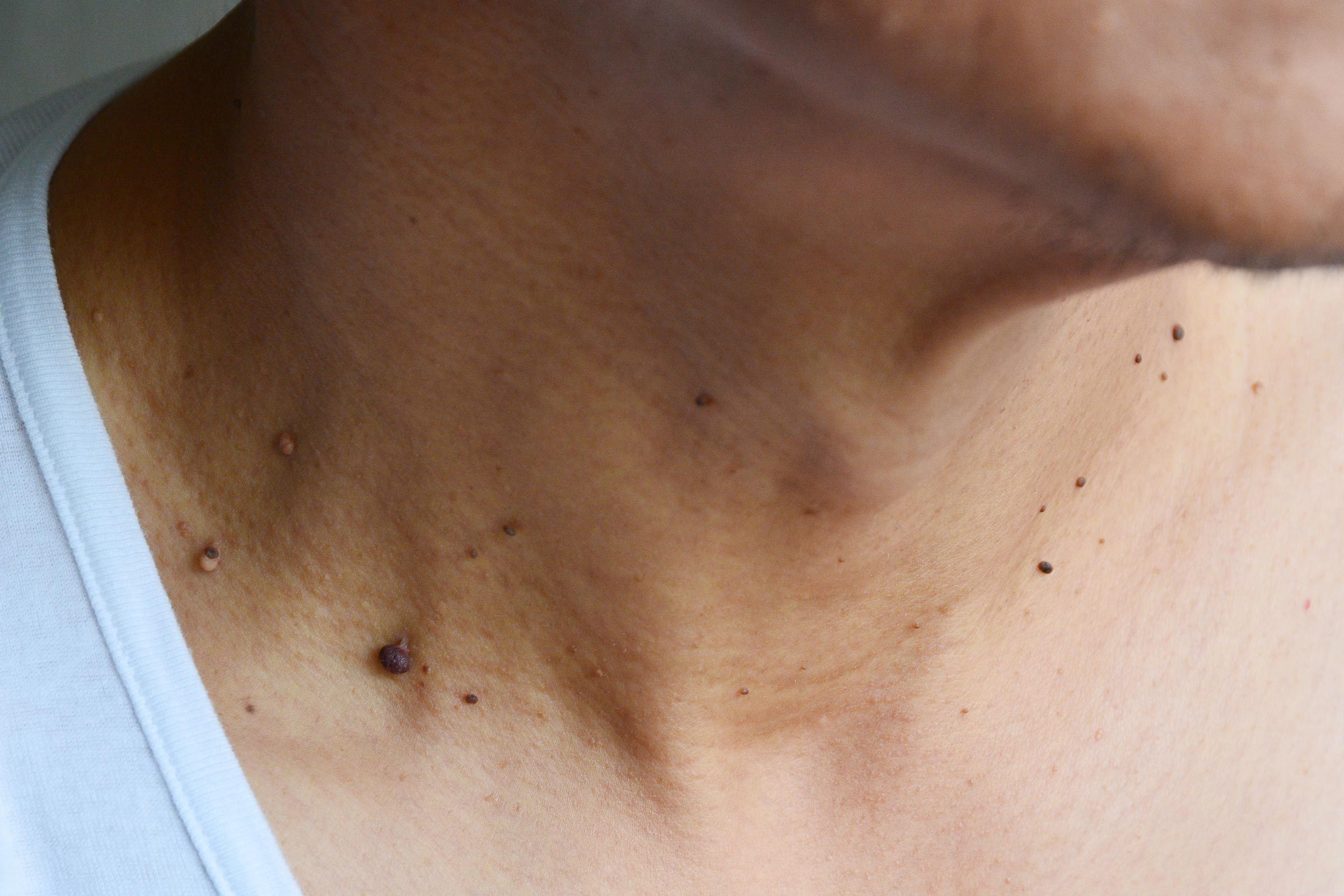 13 Silent Signs of Skin Cancer You're Probably Ignoring