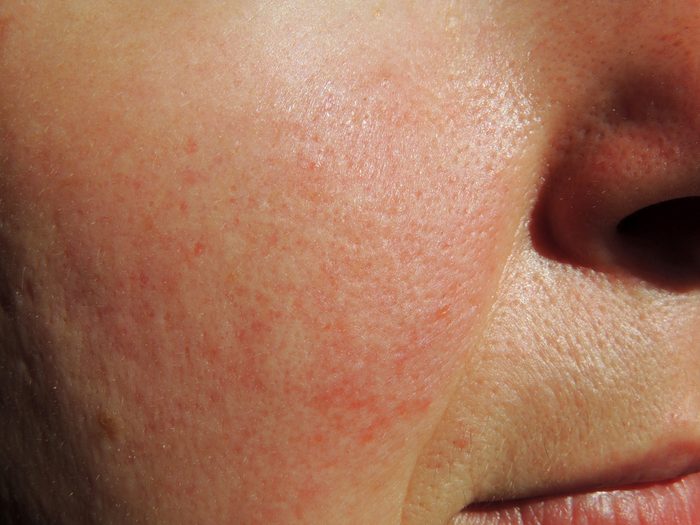 Rosacea on face of middle aged woman