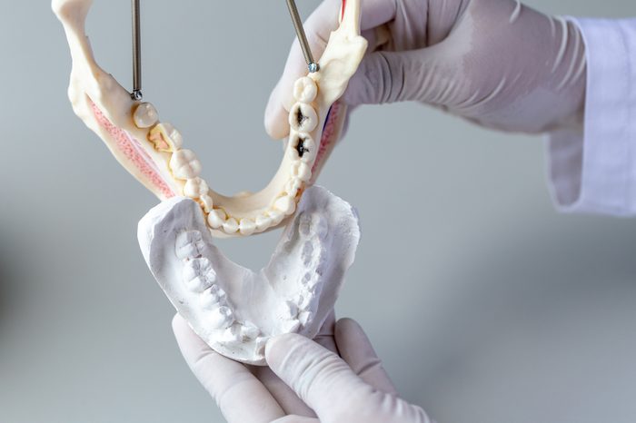 gloved hands holding up plaster tooth molds