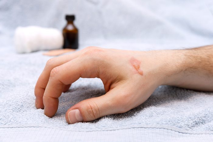 Burn blister on the hand in the hospital