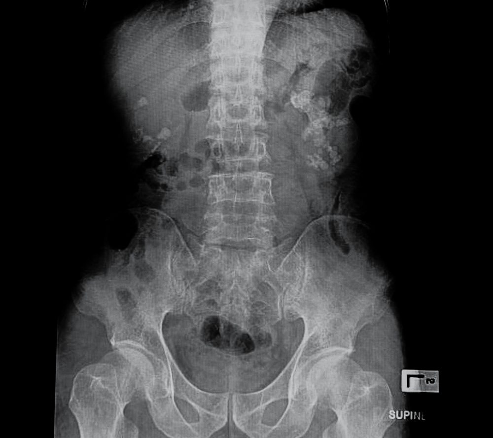 xray showed kidney stones