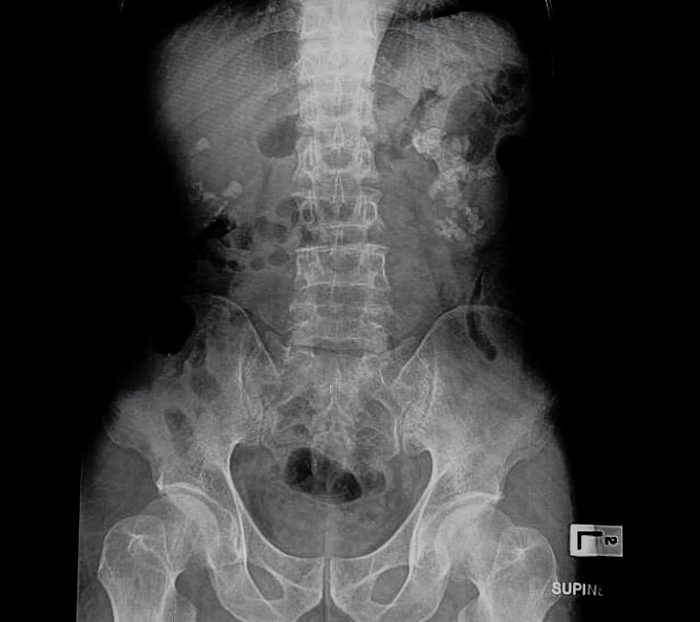 xray showed kidney stones