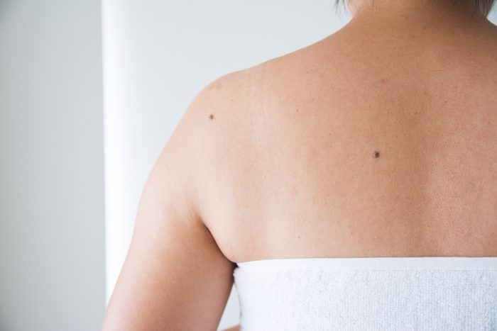 Moles on the women skin