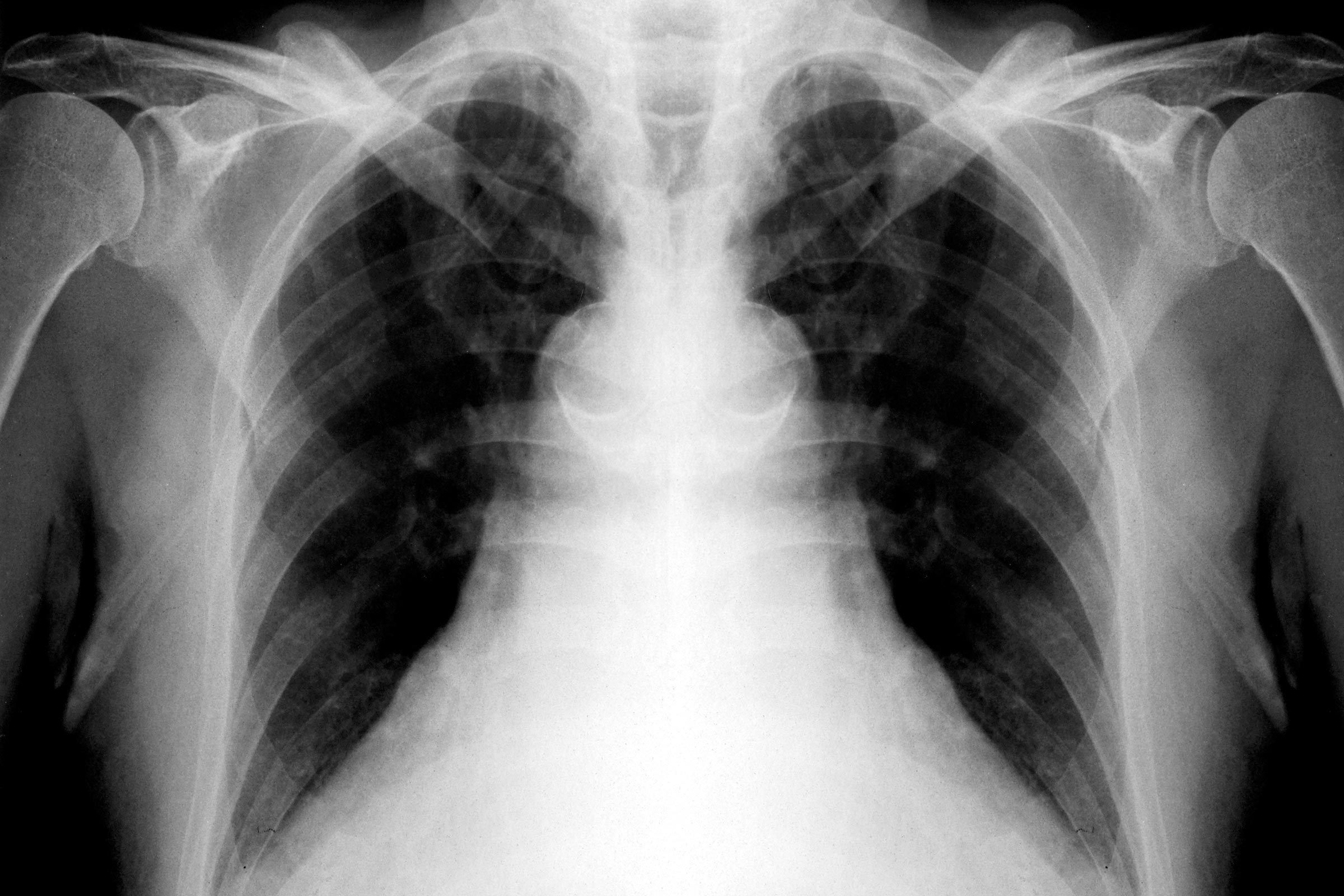 chest x-ray