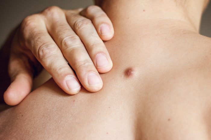 Fibroma on man's back