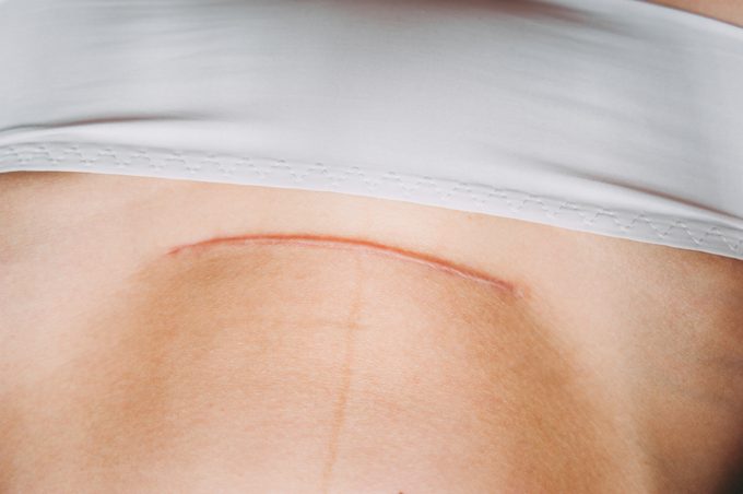 Closeup of woman belly with a scar from a cesarean section