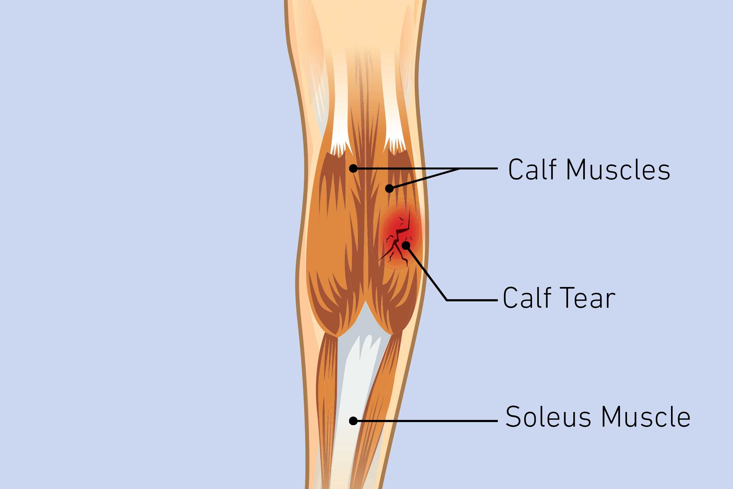 calf strain