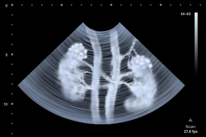 10 Hidden Signs of Kidney Cancer You're Likely to Ignore