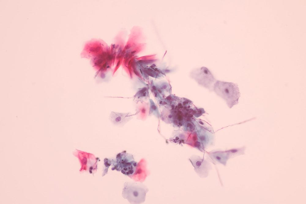 View in microscopic Candida albicans infecion in Pap smear.Fungal infection.Medical background.