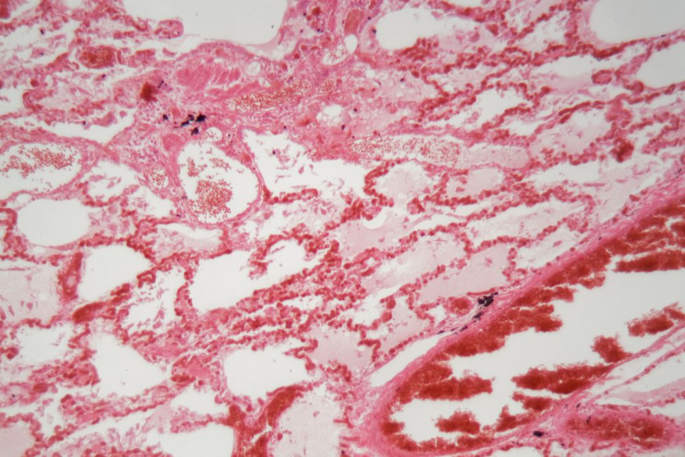 Human lung tissue with pneumonia infection caused by flu (Viral pneumonia) under a microscope.