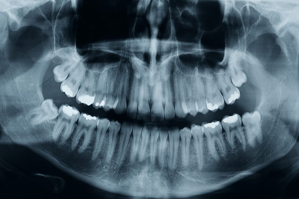 Dental xray shows 3 wisdom tooths. there is one critical in the lower part of the picture, this is a high resolution, photo