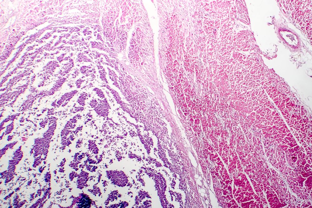 Histopathology of bacterial myocarditis, inflammatory heart disease, light micrograph
