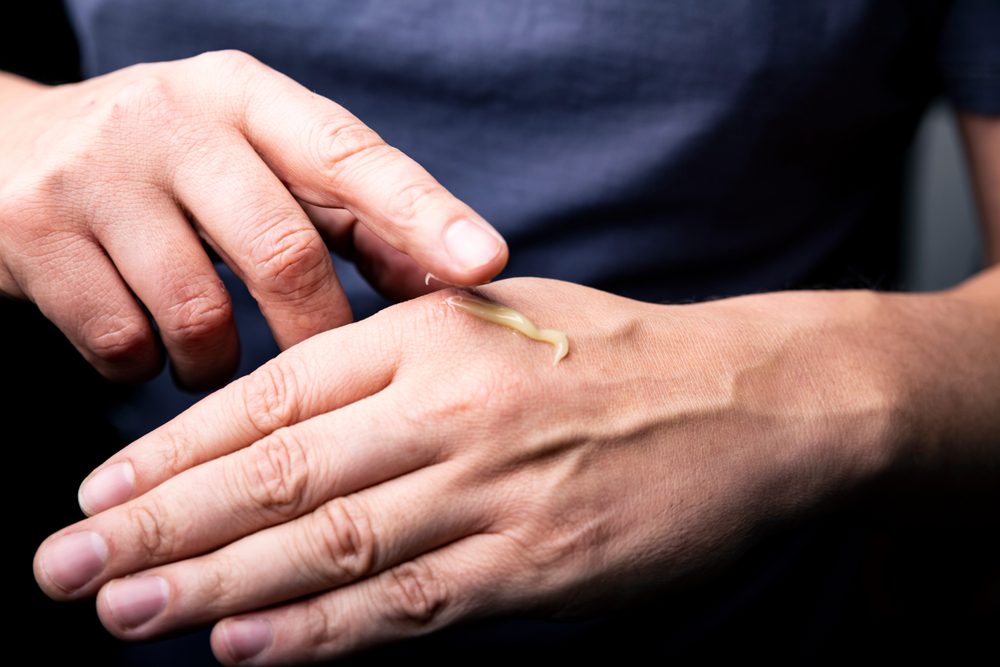 Ointment. The man smears his hand.