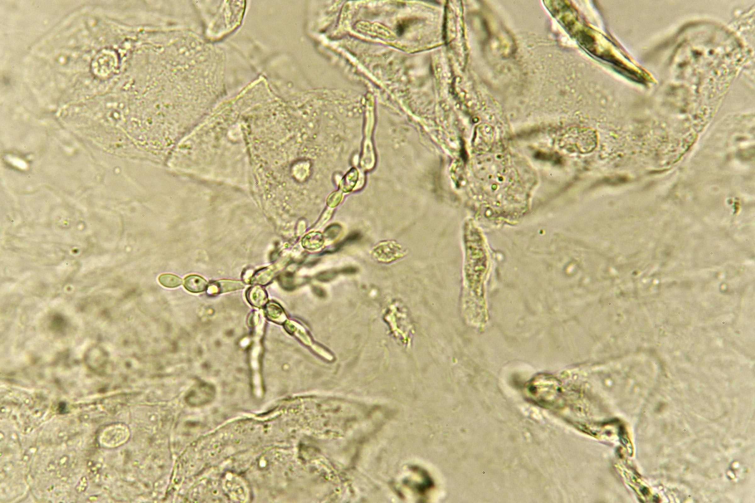 13 Common Infections That Can Raise Your Heart Attack Risk