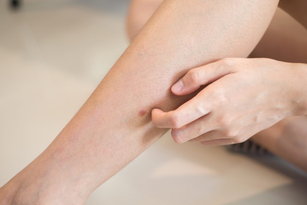 Woman hand scratching on leg, Concept with Healthcare And Medicine.
