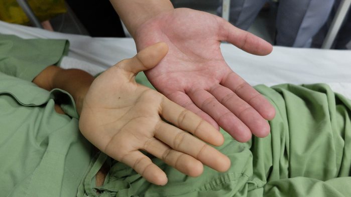 Jaundice , yellowish discoloration of skin and sclera. Comparing normal and diseased hand.