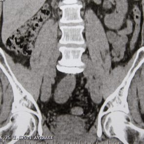 This is How Long It Takes to Pass a Kidney Stone