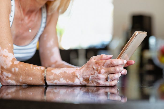 vitiligo on woman's arms
