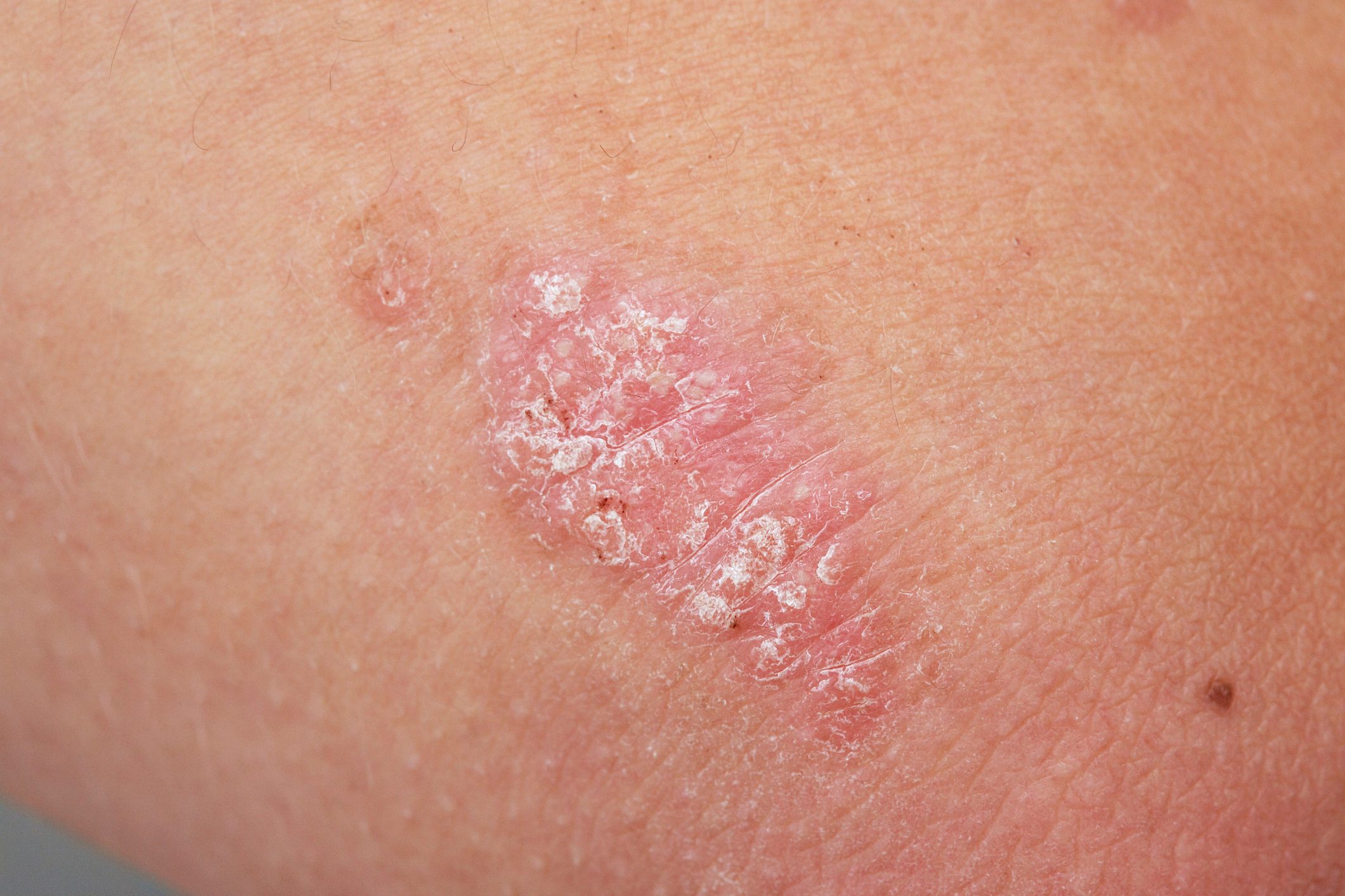 New Study: This Common Skin Condition May Spike Your Risk of 16 Cancers