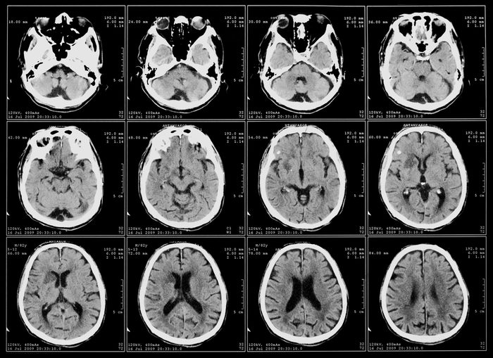 x-ray film of the brain computed tomography