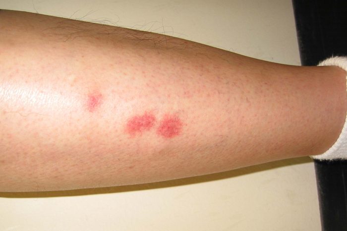 bed bug bite pictures