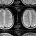 Munchausen Syndrome by Proxy: The Rare Mental Health Problem Behind the Gypsy Rose Case
