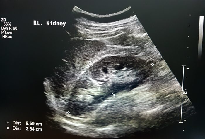 Kidney Ultrasound