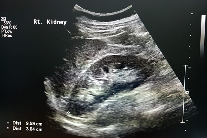 Kidney Ultrasound