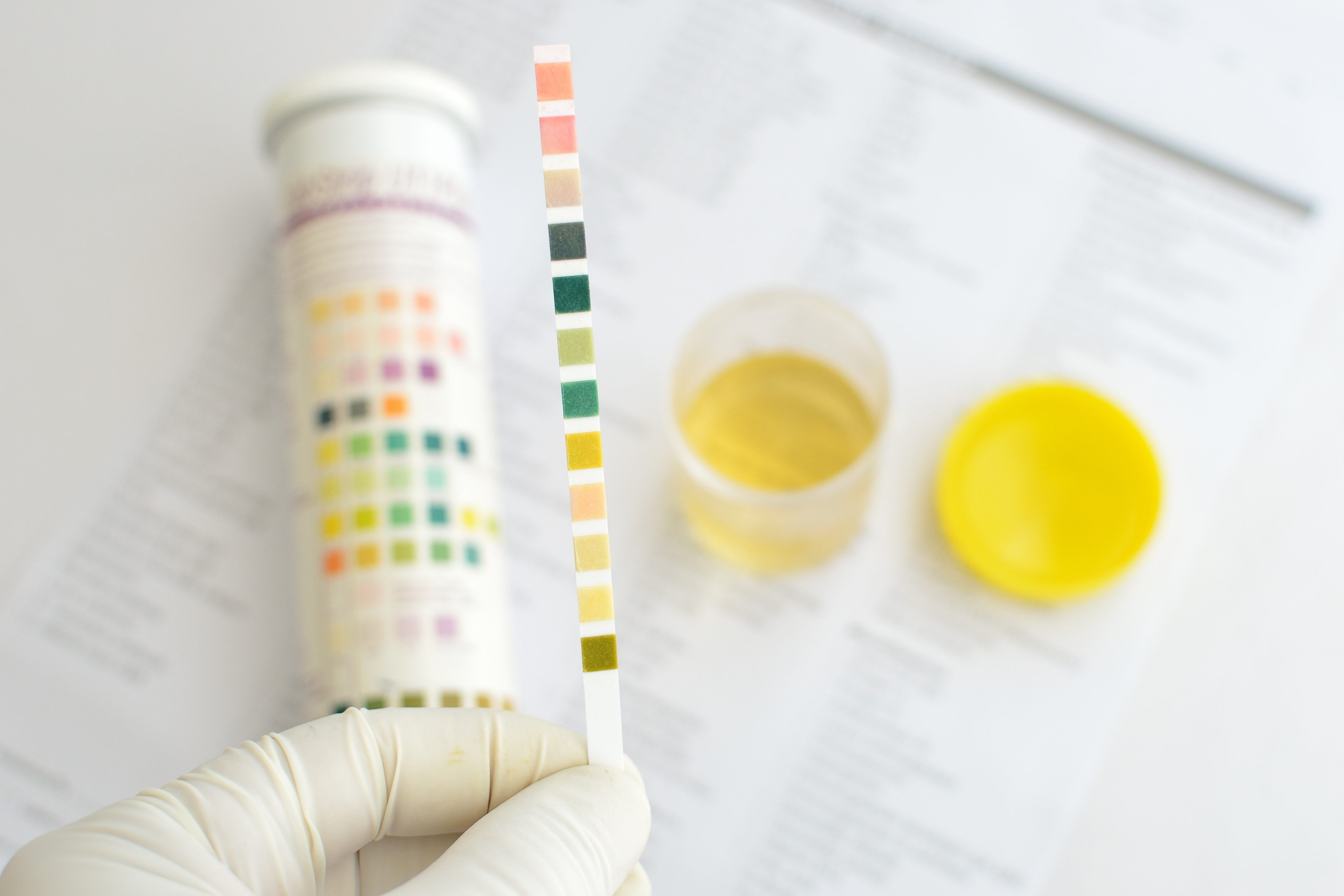 Urine analysis