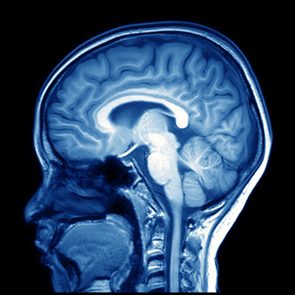 magnetic resonance image (MRI) of the brain