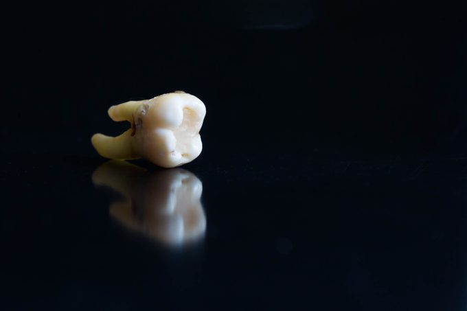 photo of broken tooth after extraction