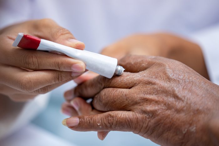 Selective focus close up woman pharmacist or doctor hand apply steroid moisturizer cream on old asian man hand with flaking dry itchy skin conditions peeling by allergic dermatitis.
